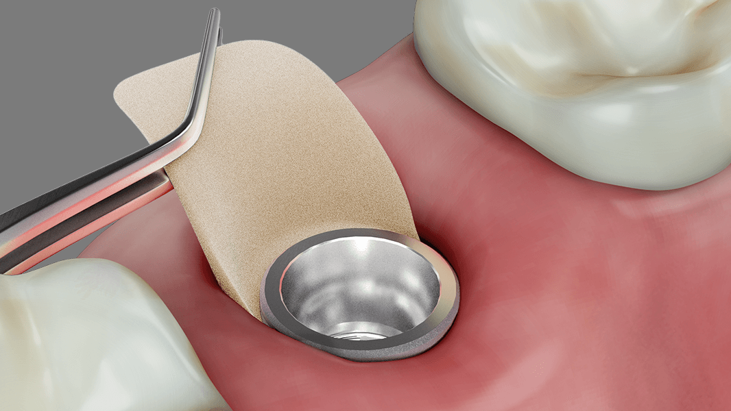 Zagęszczanie tkanek wokół implantów i zębów z zastosowaniem techniki płata
